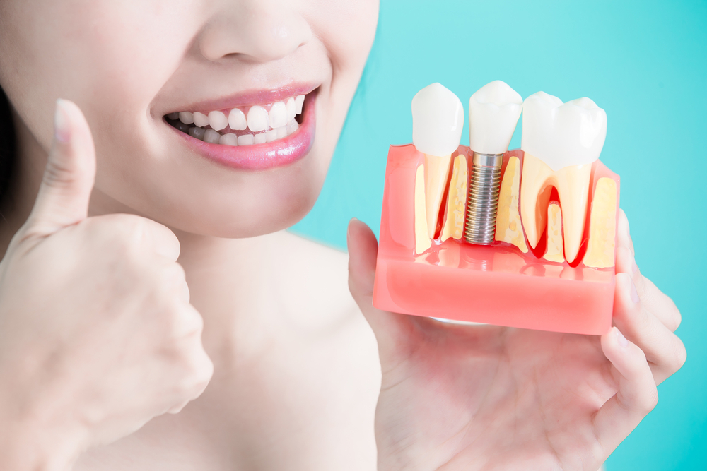 how to maintain your dental implants for longevity